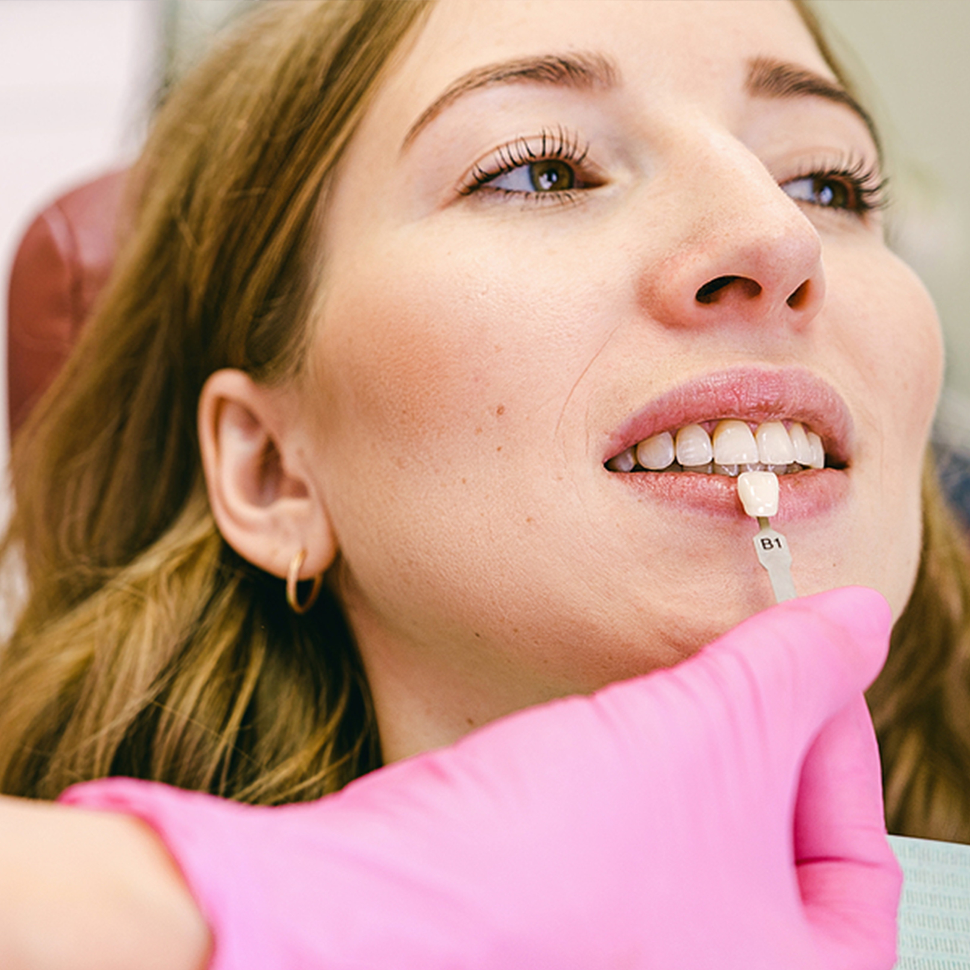 Veneers Veneers