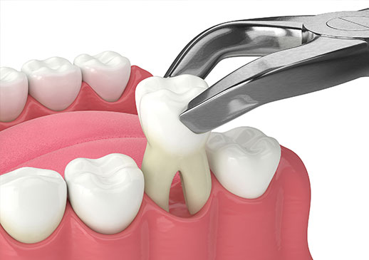 Wisdom Teeth Removal Wisdom Teeth Removal